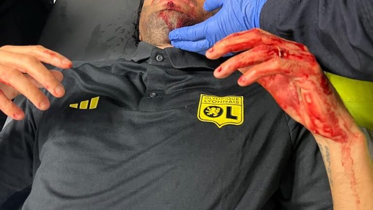 Fabio Grosso, entraîneur de l'OL, blessé au visage.